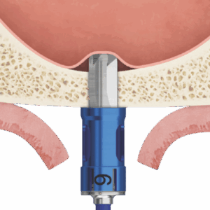 Flat Sinus Floor