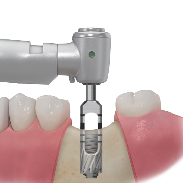taper-ultra-kit-trephine-drill-removing-failed-implant-02
