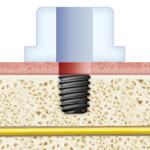 6mm Short Implant