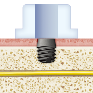 4mm Ex. Short Implant