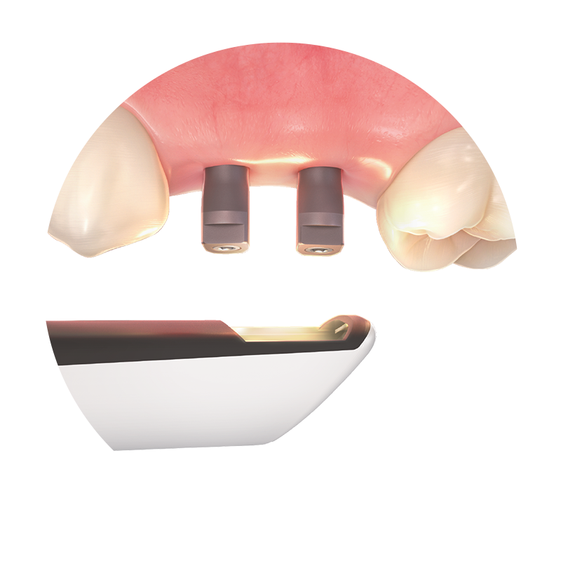 Impression Copings & Scan Bodies
