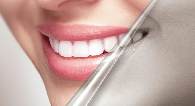 After teeth whitening result