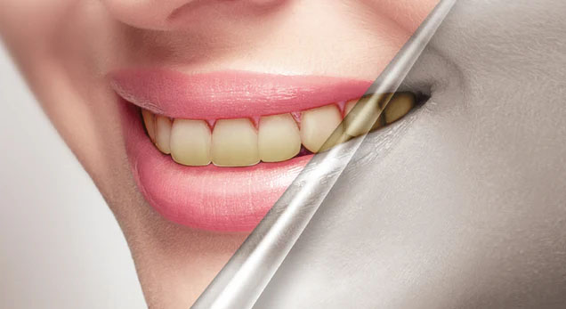 Before teeth whitening result